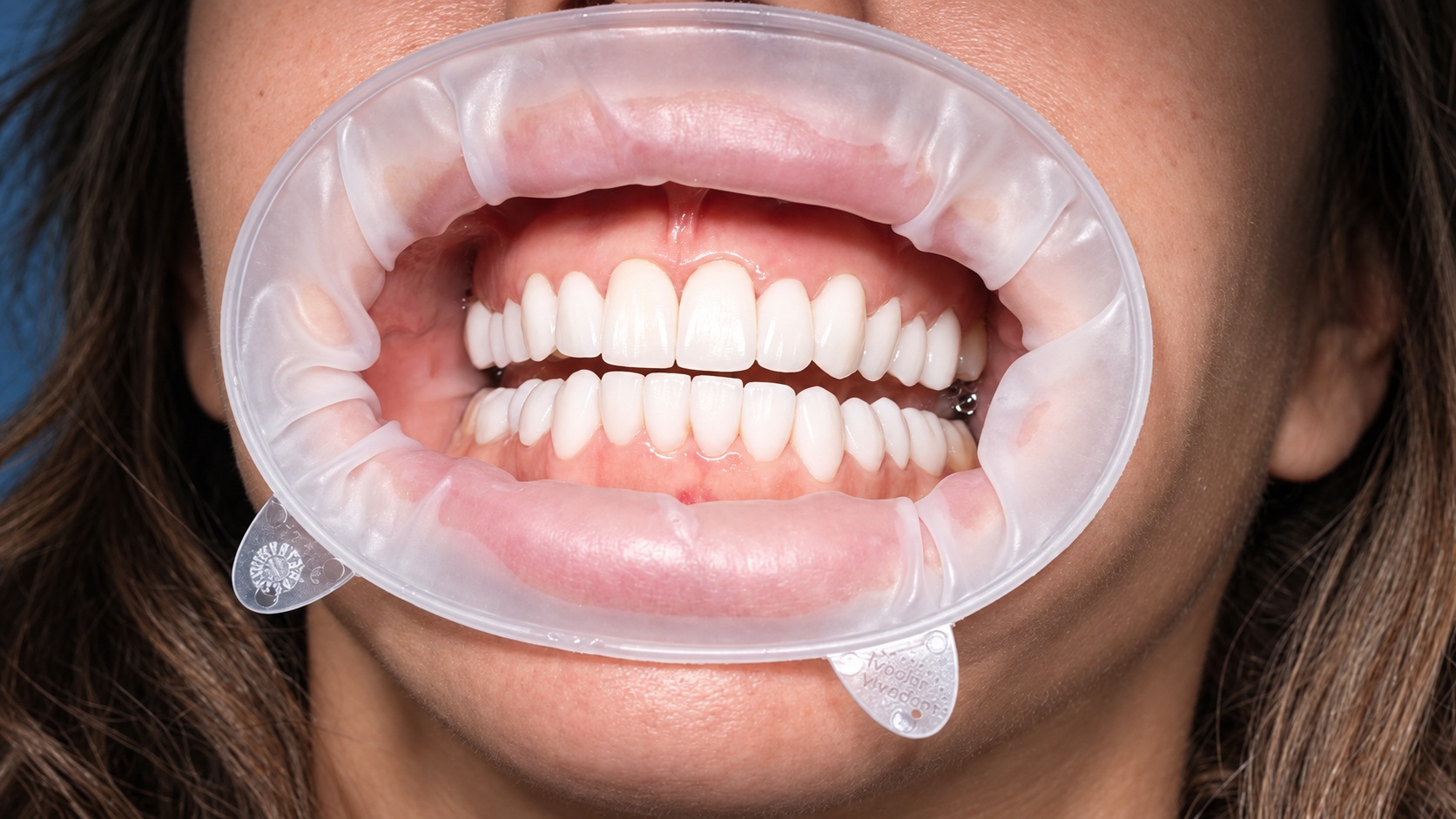 Los detalles de su dentadura · Recreación editorial